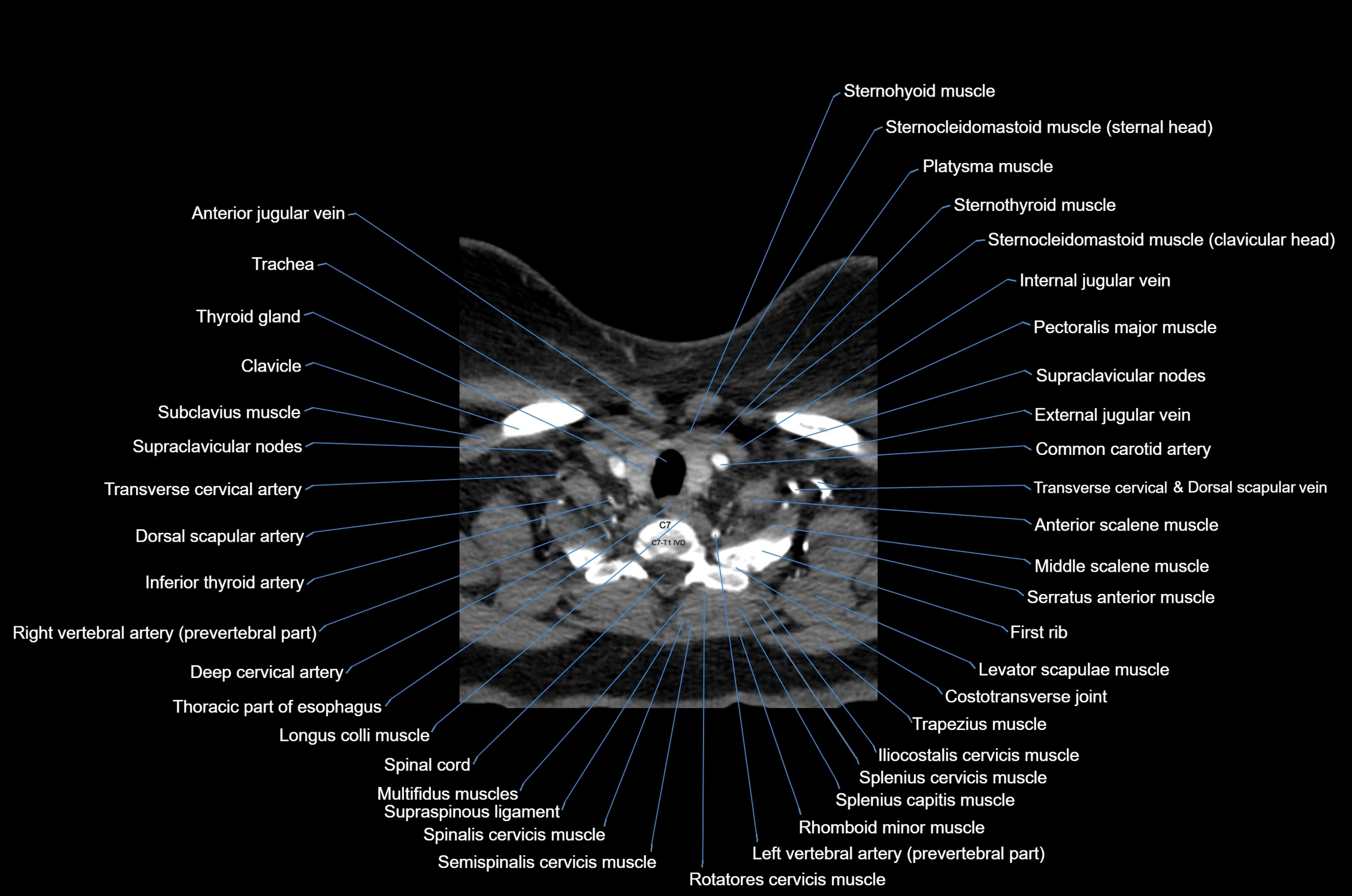 CT Neck axial cross sectional anatomy radiology image-img-00001-00052.webp